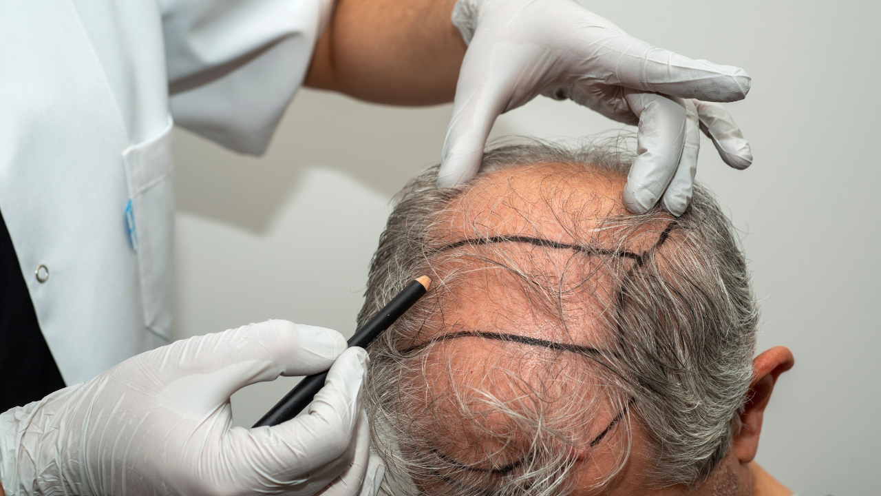 Hair Transplant in Casablanca Morocco